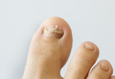 Toe nail fungus