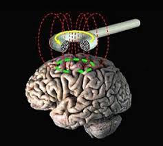 Transcranial Magnetic Stimulation