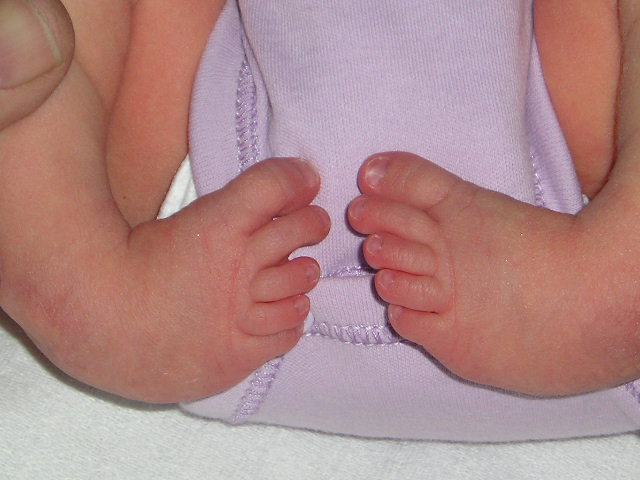bilateral clubfoot
