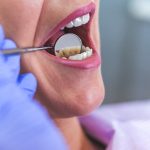 5 Habits That Cause Bad Teeth
