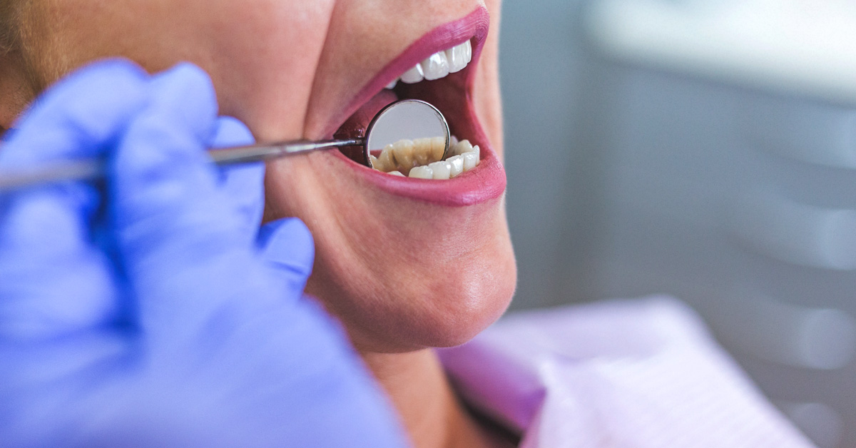 5 Habits That Cause Bad Teeth