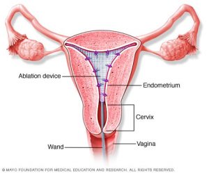 My Endometrial Ablation Experience