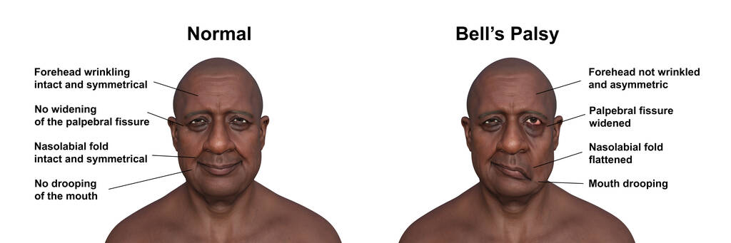 Bell's Palsy