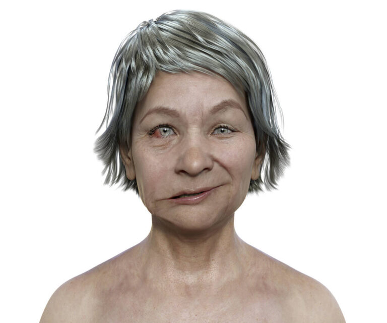 Bell's Palsy