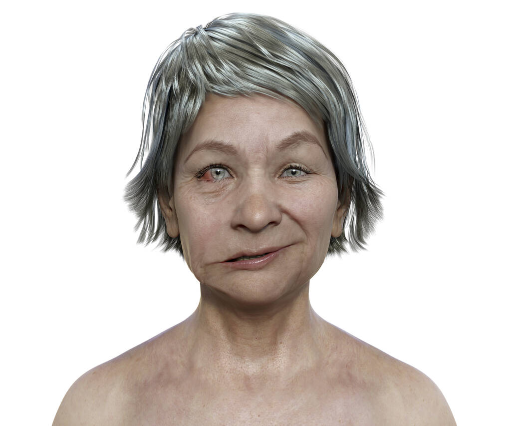 Bell's Palsy