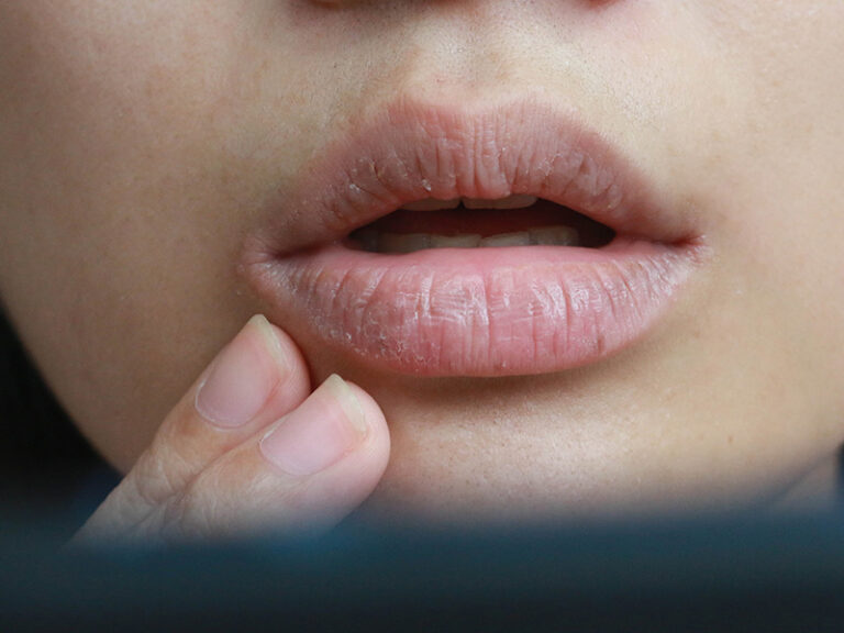 Dry Mouth Causes : What Are the Common Culprits?