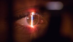 Consider Laser Eye Surgery