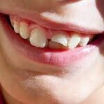 Best Reasons To Fix Your Chipped Tooth