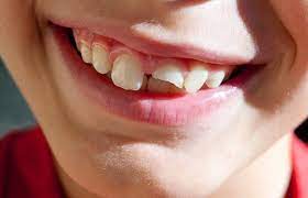 Best Reasons To Fix Your Chipped Tooth