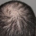 Is Your Spouse’s Hair Falling Out? The Top 5 Causes of Hair Loss in Males