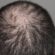 Hair Loss in Men – Causes, Prevention, and Treatment