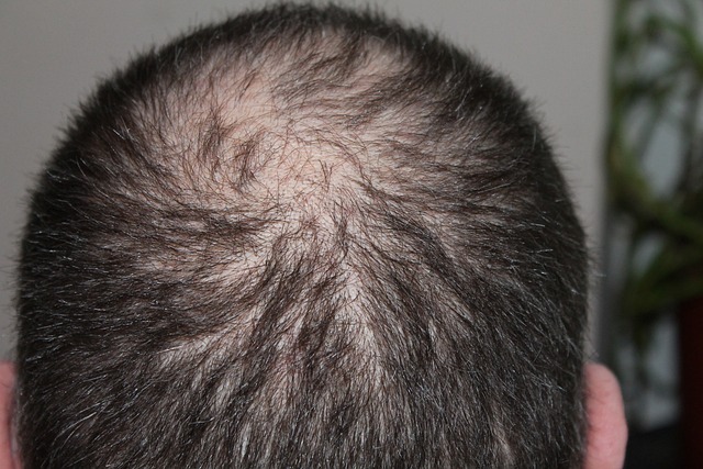 Is Your Spouse’s Hair Falling Out? The Top 5 Causes of Hair Loss in Males