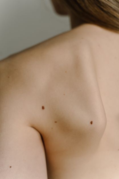 skin moles