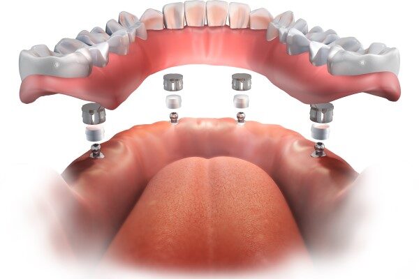 All On 4 Dental Implant Turkey