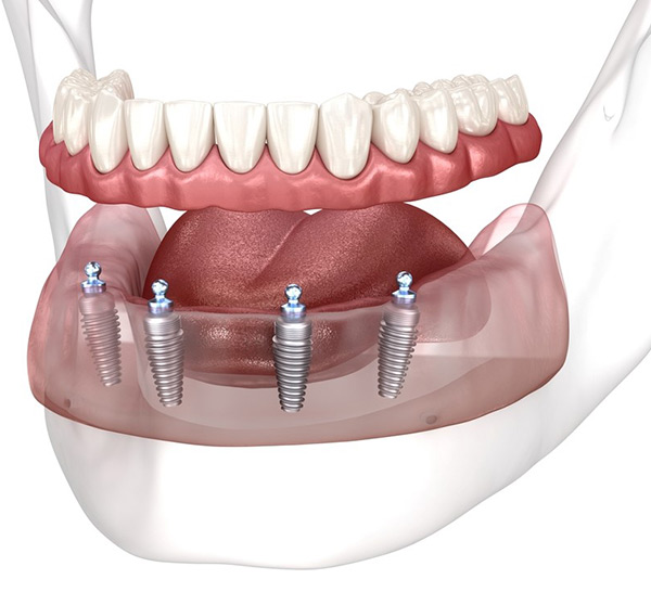 All On 4 Dental Implant