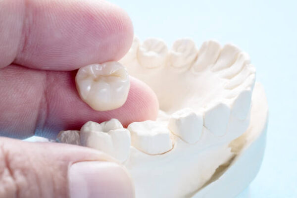 Understanding Dental Crowns: Types, Benefits, and Procedure