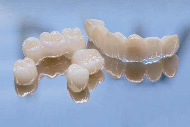 Dental Crowns