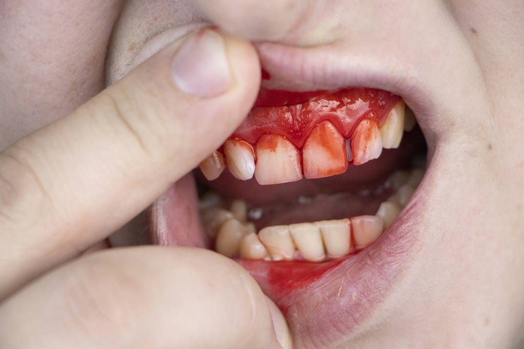 Dental Injuries