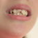 What to Do if Your Child Damages a Tooth While Playing