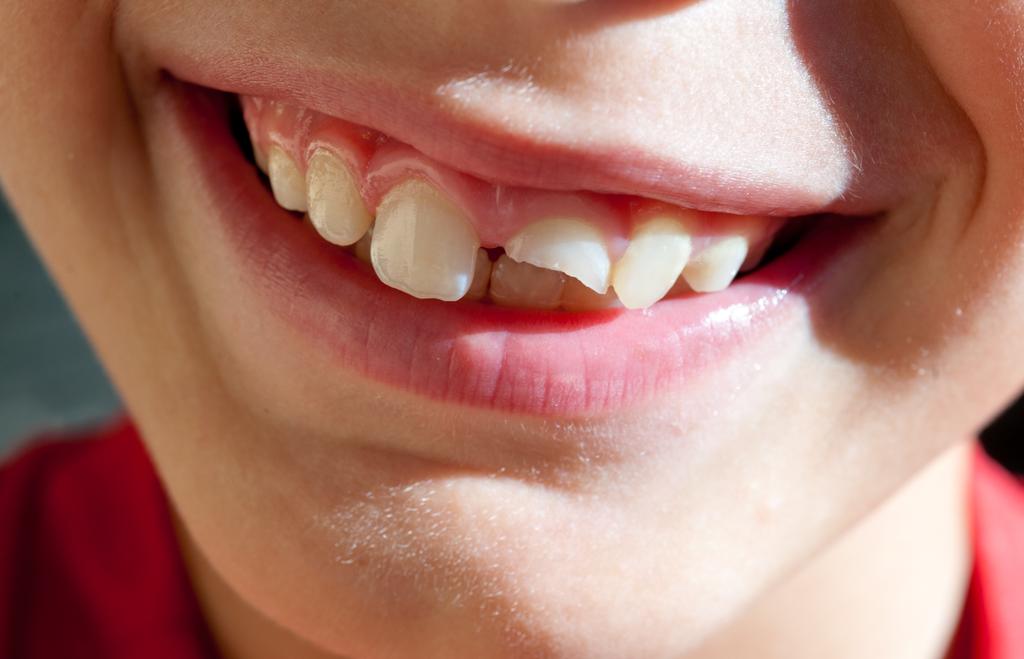 child damages a tooth 