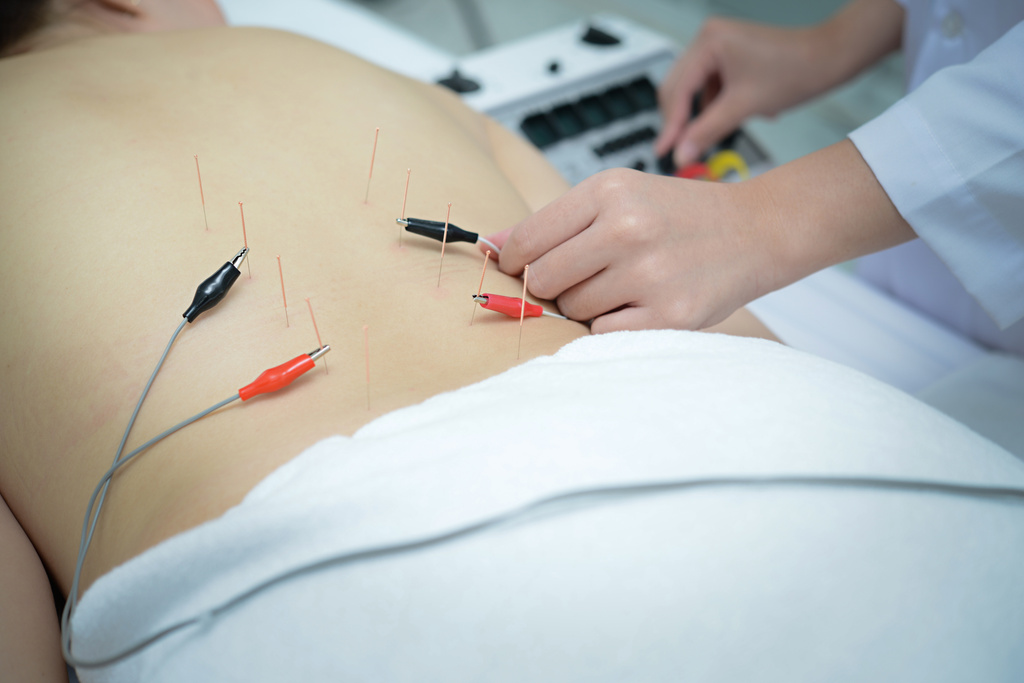 acupuncture