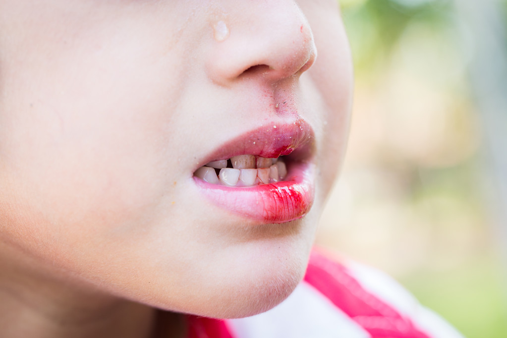 child damages a tooth 