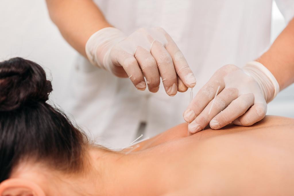 acupuncture