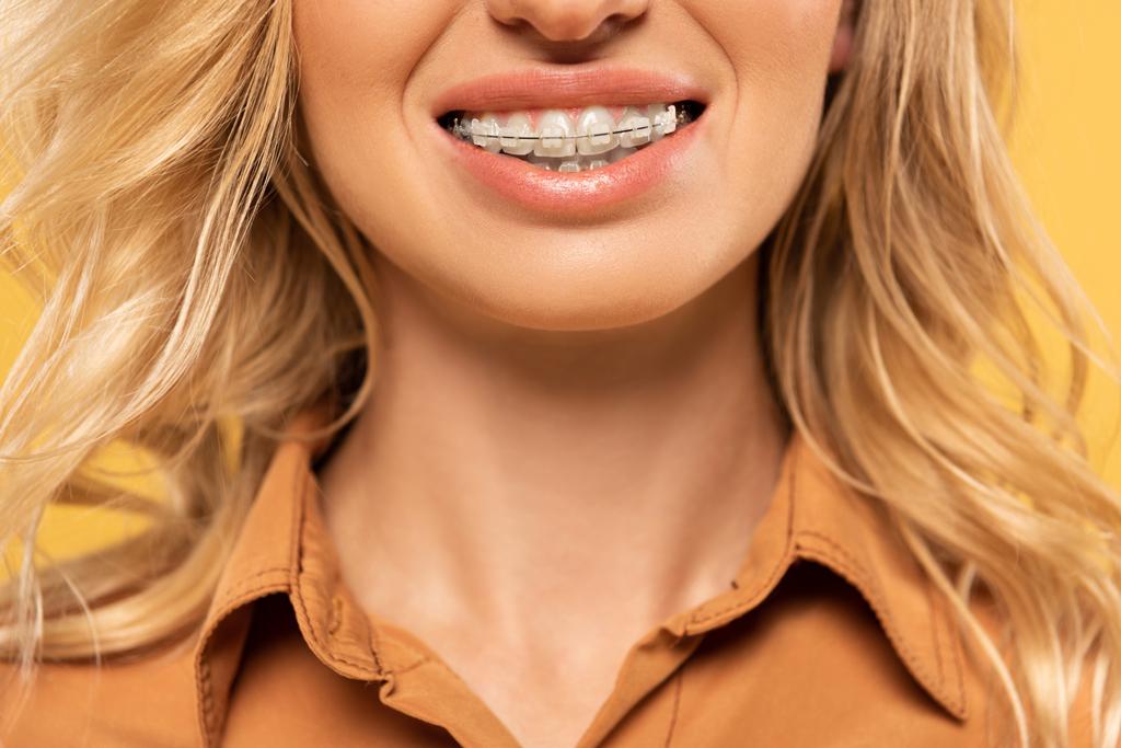 dental braces