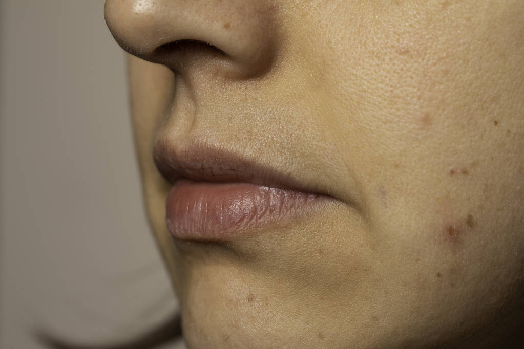 Young woman with rash on cheek close up