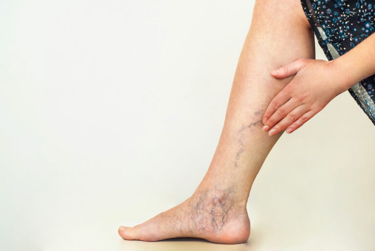 Varicose Vein