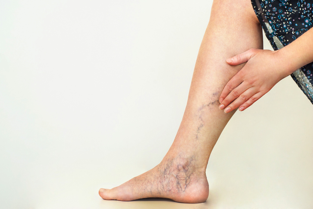 Varicose Vein