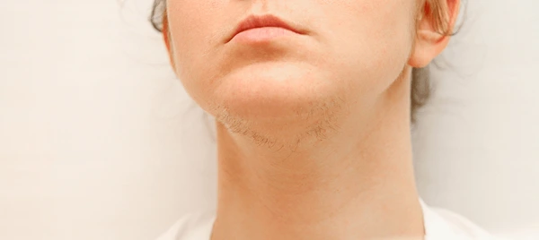 chin hair women 