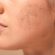 How Laser Skin Resurfacing Can Rejuvenate Your Look