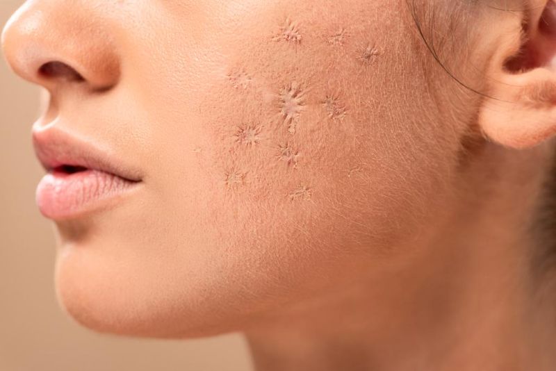  Laser skin resurfacing