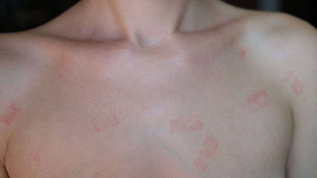 Skin Irritation