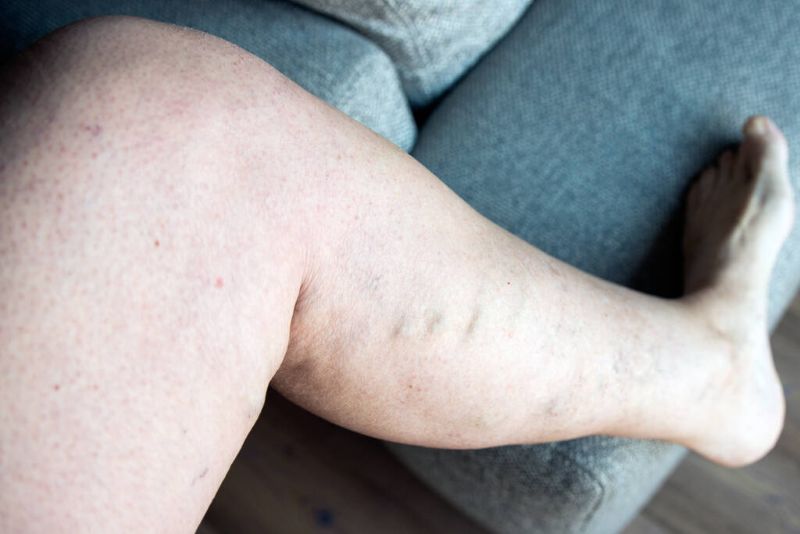 Why Vascular Diseases Often Go Unnoticed