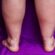 Reasons why Vascular Diseases Often Go Unnoticed