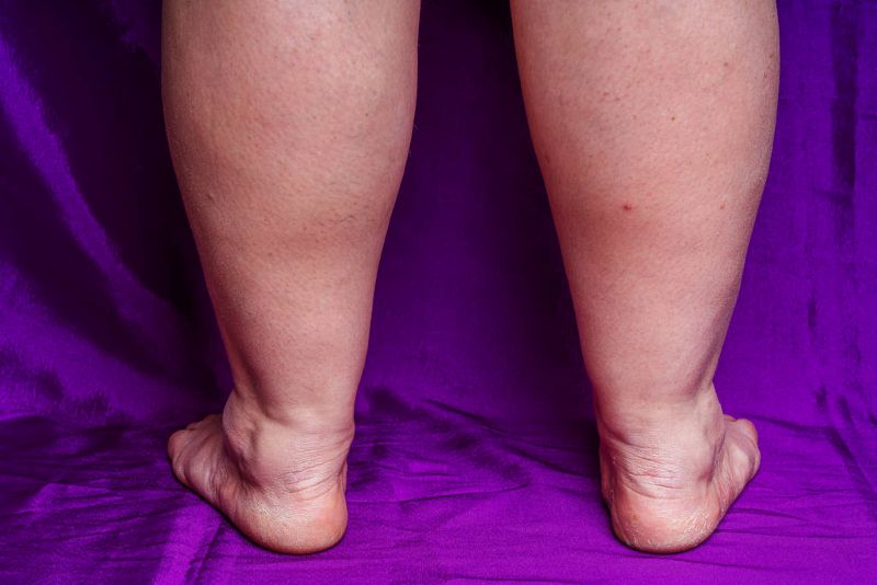 Vascular Diseases
