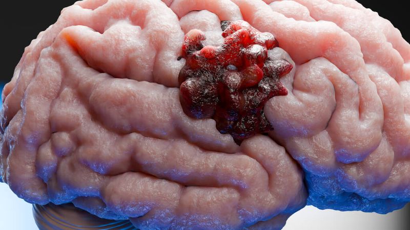 neural cancer
