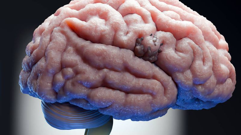 May is Brain Tumor Awareness Month in Canada