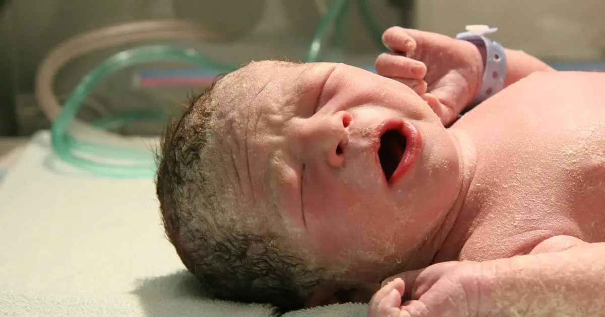 meconium aspiration syndrome