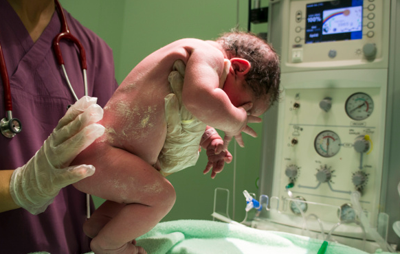 meconium aspiration syndrome