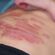 How to Manage a Chronic Skin Condition with Ease