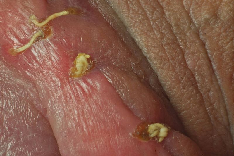 lichen sclerosus
