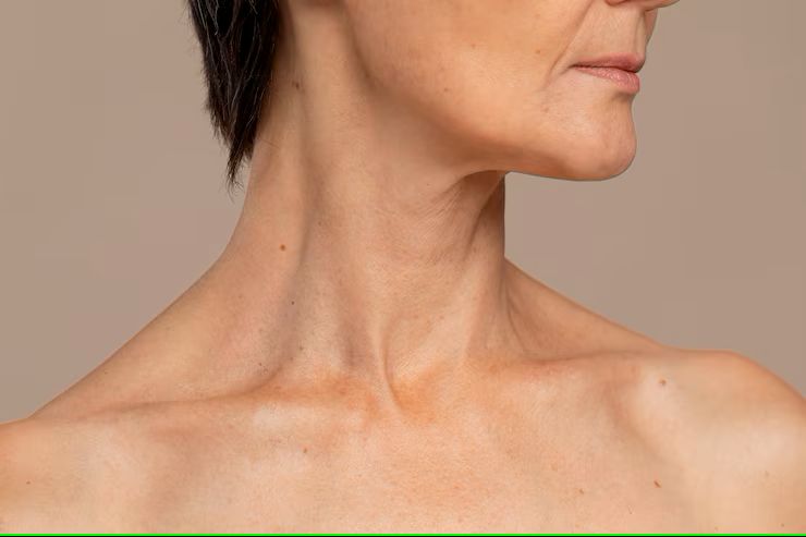 neck lift