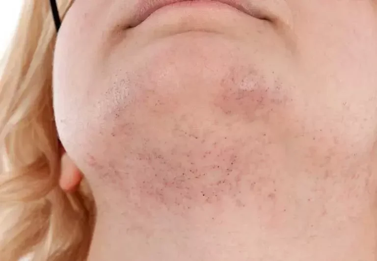 women chin hair