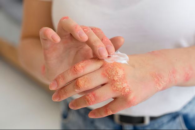  Psoriasis