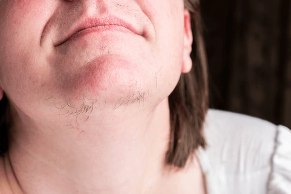 women chin hair