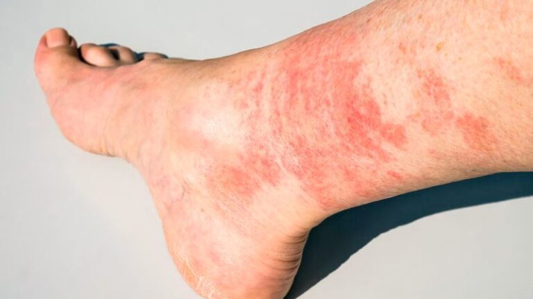 Disney rash