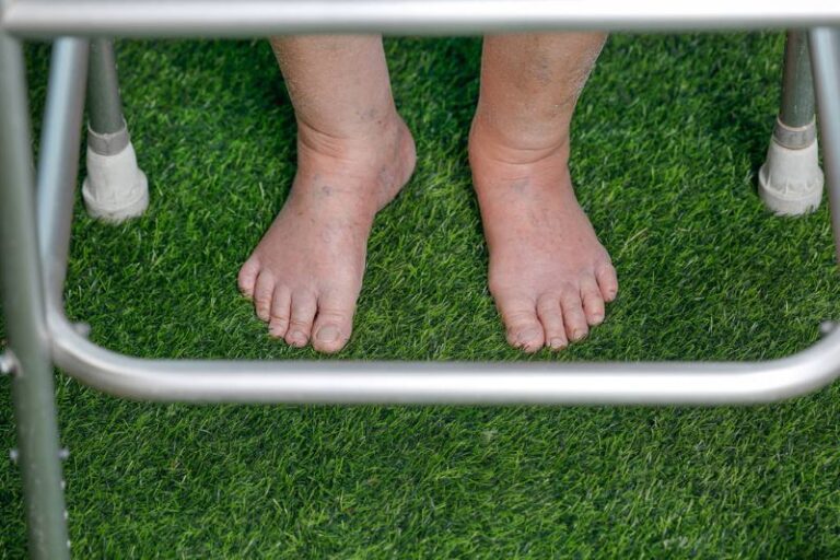 Unpacking the Link Between Fluid Retention and Your Heart